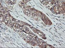 PTP1B Antibody - IHC of paraffin-embedded Adenocarcinoma of Human ovary tissue using anti-PTPN1 mouse monoclonal antibody. (Heat-induced epitope retrieval by 10mM citric buffer, pH6.0, 100C for 10min).