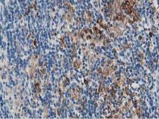PTP1B Antibody - IHC of paraffin-embedded Human lymphoma tissue using anti-PTPN1 mouse monoclonal antibody.