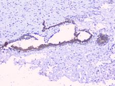 PTP1B Antibody - IHC analysis of PTP1B using anti-PTP1B antibody. PTP1B was detected in paraffin-embedded section of human mammary cancer tissues. Heat mediated antigen retrieval was performed in citrate buffer (pH6, epitope retrieval solution) for 20 mins. The tissue section was blocked with 10% goat serum. The tissue section was then incubated with 1µg/ml rabbit anti-PTP1B Antibody overnight at 4°C. Biotinylated goat anti-rabbit IgG was used as secondary antibody and incubated for 30 minutes at 37°C. The tissue section was developed using Strepavidin-Biotin-Complex (SABC) with DAB as the chromogen.