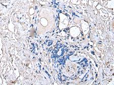 PTP4A1 / PRL-1 Antibody - Immunohistochemistry of paraffin-embedded Human thyroid cancer tissue  using PTP4A1 Polyclonal Antibody at dilution of 1:45(×200)