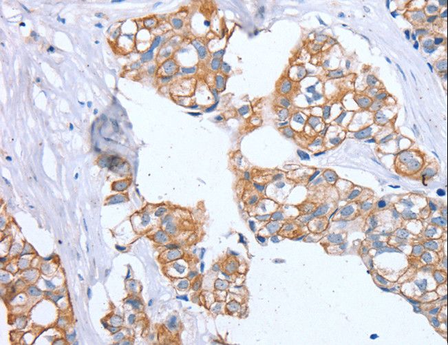 PTP4A2 / PRL-2 Antibody - Immunohistochemistry of paraffin-embedded Human breast cancer using PTP4A2 Polyclonal Antibody at dilution of 1:30.