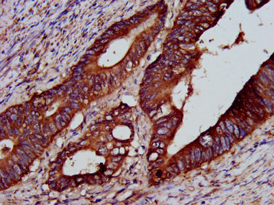 PTP4A2 / PRL-2 Antibody - Immunohistochemistry image at a dilution of 1:200 and staining in paraffin-embedded human colon cancer performed on a Leica BondTM system. After dewaxing and hydration, antigen retrieval was mediated by high pressure in a citrate buffer (pH 6.0) . Section was blocked with 10% normal goat serum 30min at RT. Then primary antibody (1% BSA) was incubated at 4 °C overnight. The primary is detected by a biotinylated secondary antibody and visualized using an HRP conjugated SP system.