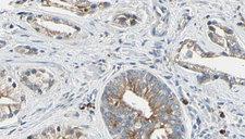 PTP4A2 / PRL-2 Antibody - 1:100 staining human prostate tissue by IHC-P. The sample was formaldehyde fixed and a heat mediated antigen retrieval step in citrate buffer was performed. The sample was then blocked and incubated with the antibody for 1.5 hours at 22°C. An HRP conjugated goat anti-rabbit antibody was used as the secondary.
