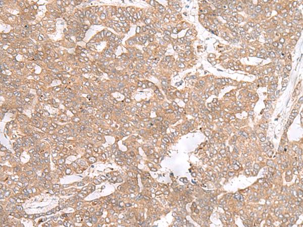 PTP4A3 Antibody - Immunohistochemistry of paraffin-embedded Human liver cancer tissue  using PTP4A3 Polyclonal Antibody at dilution of 1:40(×200)