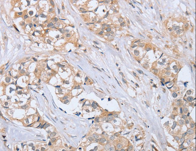 PTPMEG / PTPN4 Antibody - Immunohistochemistry of paraffin-embedded Human breast cancer using PTPN4 Polyclonal Antibody at dilution of 1:40.
