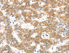 PTPMEG / PTPN4 Antibody - Immunohistochemistry of paraffin-embedded Human lung cancer using PTPN4 Polyclonal Antibody at dilution of 1:40.
