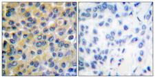 PTPN11 / SHP-2 / NS1 Antibody - Immunohistochemistry analysis of paraffin-embedded human breast carcinoma tissue, using SHP-2 Antibody. The picture on the right is blocked with the synthesized peptide.