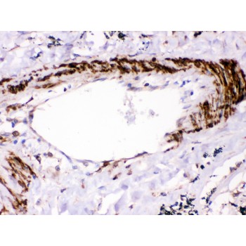 PTPN11 / SHP-2 / NS1 Antibody - SHP2 antibody IHC-paraffin. IHC(P): Human Lung Cancer Tissue.
