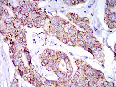 PTPN11 / SHP-2 / NS1 Antibody - IHC of paraffin-embedded breast cancer tissues using PTPN11 mouse monoclonal antibody with DAB staining.