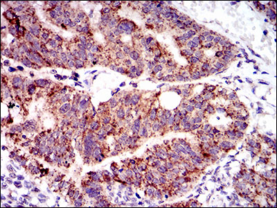 PTPN11 / SHP-2 / NS1 Antibody - IHC of paraffin-embedded rectum cancer tissues using PTPN11 mouse monoclonal antibody with DAB staining.