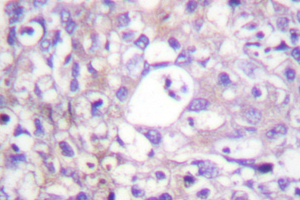 PTPN11 / SHP-2 / NS1 Antibody - IHC of SH-PTP2 (E574) pAb in paraffin-embedded human breast carcinoma tissue.