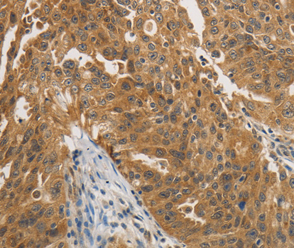PTPN11 / SHP-2 / NS1 Antibody - Immunohistochemistry of paraffin-embedded human ovarian cancer tissue.