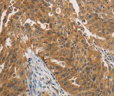 PTPN11 / SHP-2 / NS1 Antibody - Immunohistochemistry of paraffin-embedded human ovarian cancer tissue.