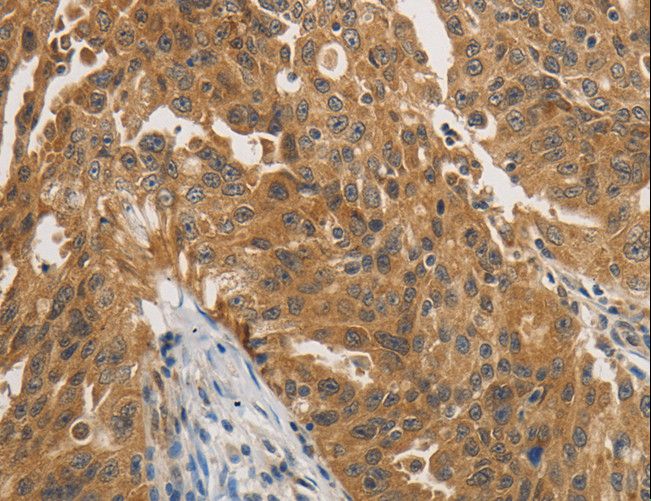 PTPN11 / SHP-2 / NS1 Antibody - Immunohistochemistry of paraffin-embedded Human ovarian cancer using PTPN11 Polyclonal Antibody at dilution of 1:25.