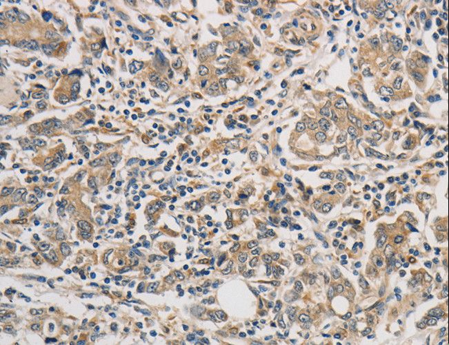 PTPN11 / SHP-2 / NS1 Antibody - Immunohistochemistry of paraffin-embedded Human gastric cancer using PTPN11 Polyclonal Antibody at dilution of 1:25.