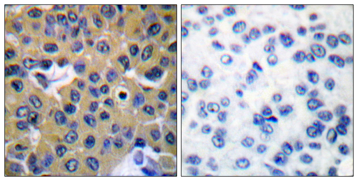 PTPN11 / SHP-2 / NS1 Antibody - Immunohistochemistry analysis of paraffin-embedded human breast carcinoma, using SHP-2 (Phospho-Tyr542) Antibody. The picture on the right is blocked with the phospho peptide.