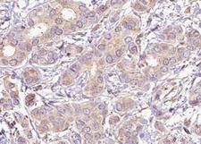 PTPN11 / SHP-2 / NS1 Antibody - 1:100 staining human breast carcinoma tissue by IHC-P. The tissue was formaldehyde fixed and a heat mediated antigen retrieval step in citrate buffer was performed. The tissue was then blocked and incubated with the antibody for 1.5 hours at 22°C. An HRP conjugated goat anti-rabbit antibody was used as the secondary.