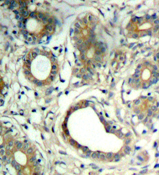 PTPN11 / SHP-2 / NS1 Antibody - Immunohistochemical analysis of paraffin-embedded human breast carcinoma tissue.