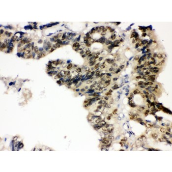 PTPN2 / TC-PTP Antibody - TCPTP antibody IHC-paraffin. IHC(P): Human Intestinal Cancer Tissue.