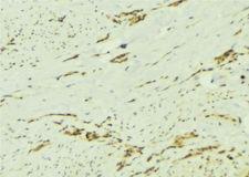 PTPN2 / TC-PTP Antibody - 1:100 staining human breast carcinoma tissue by IHC-P. The sample was formaldehyde fixed and a heat mediated antigen retrieval step in citrate buffer was performed. The sample was then blocked and incubated with the antibody for 1.5 hours at 22°C. An HRP conjugated goat anti-rabbit antibody was used as the secondary.