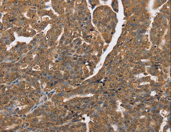 PTPN20 Antibody - Immunohistochemistry of paraffin-embedded Human lung cancer using PTPN20A/PTPN20B Polyclonal Antibody at dilution of 1:40.