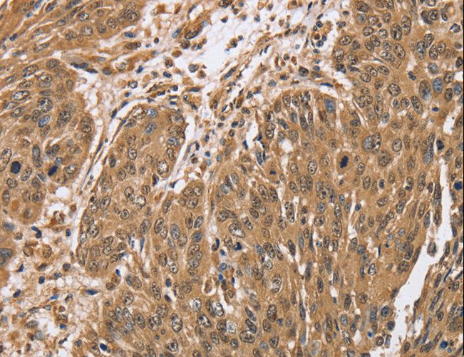 PTPN20 Antibody - Immunohistochemistry of paraffin-embedded Human lung cancer using PTPN20A/PTPN20B Polyclonal Antibody at dilution of 1:40.
