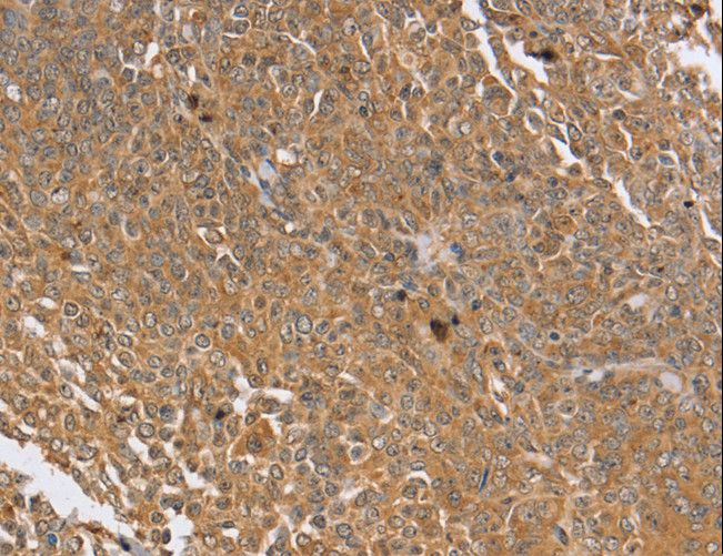 PTPN20 Antibody - Immunohistochemistry of paraffin-embedded Human cervical cancer using PTPN20B Polyclonal Antibody at dilution of 1:30.
