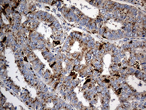 PTPN22 / PEP Antibody - Immunohistochemical staining of paraffin-embedded Adenocarcinoma of Human endometrium tissue using anti-PTPN22 mouse monoclonal antibody. (Heat-induced epitope retrieval by 1mM EDTA in 10mM Tris buffer. (pH8.5) at 120°C for 3 min. (1:1000)