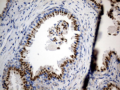 PTPN22 / PEP Antibody - Immunohistochemical staining of paraffin-embedded Human prostate tissue within the normal limits using anti-PTPN22 mouse monoclonal antibody. (Heat-induced epitope retrieval by 1mM EDTA in 10mM Tris buffer. (pH8.5) at 120°C for 3 min. (1:1000)