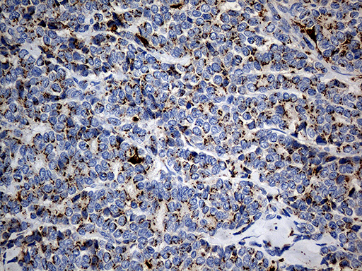 PTPN22 / PEP Antibody - Immunohistochemical staining of paraffin-embedded Adenocarcinoma of Human breast tissue tissue using anti-PTPN22 mouse monoclonal antibody. (Heat-induced epitope retrieval by 1mM EDTA in 10mM Tris buffer. (pH8.5) at 120°C for 3 min. (1:1000)