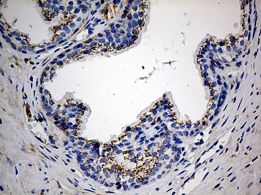 PTPN22 / PEP Antibody - Immunohistochemical staining of paraffin-embedded Carcinoma of Human prostate tissue using anti-PTPN22 mouse monoclonal antibody. (Heat-induced epitope retrieval by 1mM EDTA in 10mM Tris buffer. (pH8.5) at 120°C for 3 min. (1:1000)