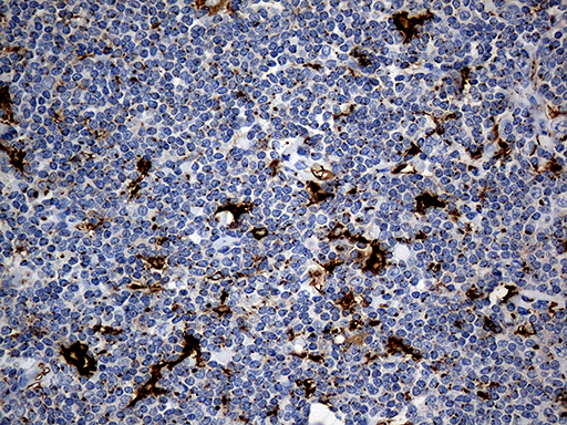 PTPN22 / PEP Antibody - Immunohistochemical staining of paraffin-embedded Human lymphoma tissue using anti-PTPN22 mouse monoclonal antibody. (Heat-induced epitope retrieval by 1mM EDTA in 10mM Tris buffer. (pH8.5) at 120°C for 3 min. (1:1000)