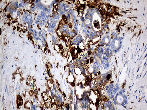 PTPN22 / PEP Antibody - Immunohistochemical staining of paraffin-embedded Adenocarcinoma of Human colon tissue using anti-PTPN22 mouse monoclonal antibody. (Heat-induced epitope retrieval by 1mM EDTA in 10mM Tris buffer. (pH8.5) at 120°C for 3 min. (1:1000)
