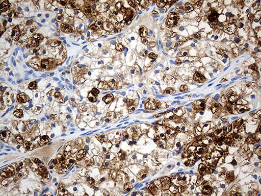PTPN22 / PEP Antibody - Immunohistochemical staining of paraffin-embedded Carcinoma of Human kidney tissue using anti-PTPN22 mouse monoclonal antibody. (Heat-induced epitope retrieval by 1mM EDTA in 10mM Tris buffer. (pH8.5) at 120°C for 3 min. (1:1000)