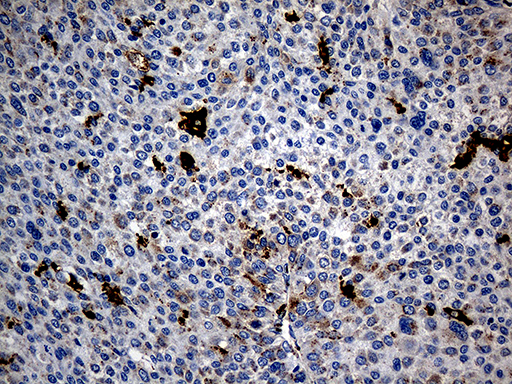 PTPN22 / PEP Antibody - Immunohistochemical staining of paraffin-embedded Carcinoma of Human liver tissue using anti-PTPN22 mouse monoclonal antibody. (Heat-induced epitope retrieval by 1mM EDTA in 10mM Tris buffer. (pH8.5) at 120°C for 3 min. (1:1000)