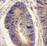 PTPN3 Antibody - Formalin-fixed and paraffin-embedded human colon carcinoma tissue reacted with PTPH1 antibody , which was peroxidase-conjugated to the secondary antibody, followed by DAB staining. This data demonstrates the use of this antibody for immunohistochemistry; clinical relevance has not been evaluated.
