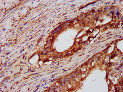 PTPN3 Antibody - Immunohistochemistry image at a dilution of 1:600 and staining in paraffin-embedded human colon cancer performed on a Leica BondTM system. After dewaxing and hydration, antigen retrieval was mediated by high pressure in a citrate buffer (pH 6.0) . Section was blocked with 10% normal goat serum 30min at RT. Then primary antibody (1% BSA) was incubated at 4 °C overnight. The primary is detected by a biotinylated secondary antibody and visualized using an HRP conjugated SP system.