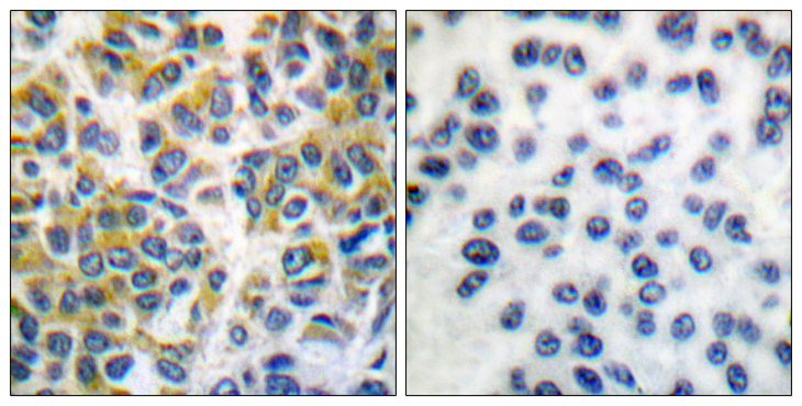 PTPN6 / SHP1 Antibody - Immunohistochemistry analysis of paraffin-embedded human breast carcinoma tissue, using SHP-1 Antibody. The picture on the right is blocked with the synthesized peptide.