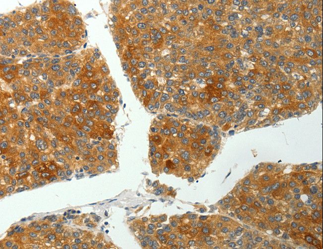 PTPN6 / SHP1 Antibody - Immunohistochemistry of paraffin-embedded Human liver cancer using PTPN6 Polyclonal Antibody at dilution of 1:35.