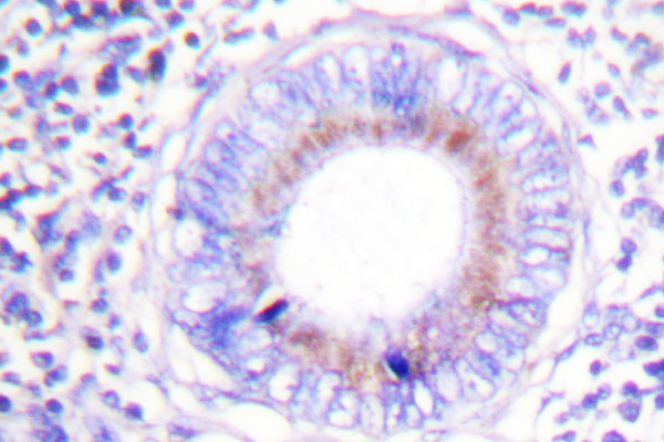 PTPN6 / SHP1 Antibody - IHC of SHP-1 (K530) pAb in paraffin-embedded human breast carcinoma colon carcinoma tissue.