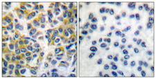 PTPN6 / SHP1 Antibody - Peptide - + Immunohistochemical analysis of paraffin-embedded human breast carcinoma tissue using SHP-1 (Ab-536) antibody.
