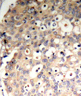 PTPN6 / SHP1 Antibody - Immunohistochemical analysis of paraffin-embedded human breast carcinoma tissue.
