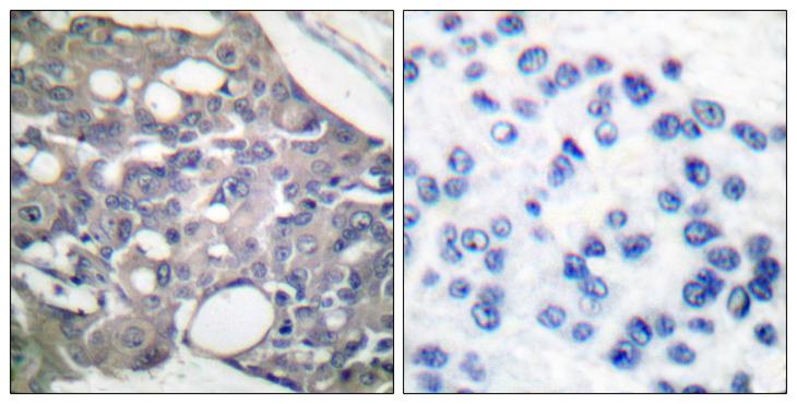 PTPN6 / SHP1 Antibody - P-peptide - + Immunohistochemical analysis of paraffin-embedded human breast carcinoma tissue using SHP-1 (phospho-Tyr536) antibody.