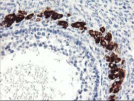 PTPN7 / HEPTP Antibody - IHC of paraffin-embedded Adenocarcinoma of Human ovary tissue using anti-PTPN7 mouse monoclonal antibody.
