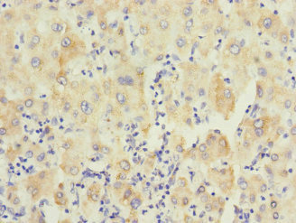PTPN7 / HEPTP Antibody - Immunohistochemistry of paraffin-embedded human liver cancer at dilution 1:100