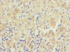 PTPN7 / HEPTP Antibody - Immunohistochemistry of paraffin-embedded human liver cancer at dilution 1:100