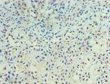 PTPRA / RPTP-Alpha Antibody - Immunohistochemistry of paraffin-embedded human breast cancer using antibody at 1:100 dilution.