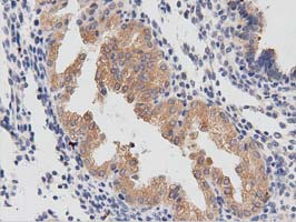 PTPRE / PTP Epsilon Antibody - IHC of paraffin-embedded Carcinoma of Human prostate tissue using anti-PTPRE mouse monoclonal antibody. (Dilution 1:50).