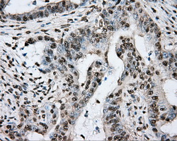 PTPRE / PTP Epsilon Antibody - IHC of paraffin-embedded Adenocarcinoma of colon tissue using anti-PTPRE mouse monoclonal antibody. (Dilution 1:50).