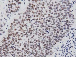 PTPRE / PTP Epsilon Antibody - IHC of paraffin-embedded Carcinoma of Human bladder tissue using anti-PTPRE mouse monoclonal antibody. (Dilution 1:50).